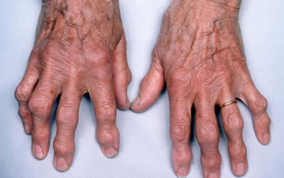 artrose handen